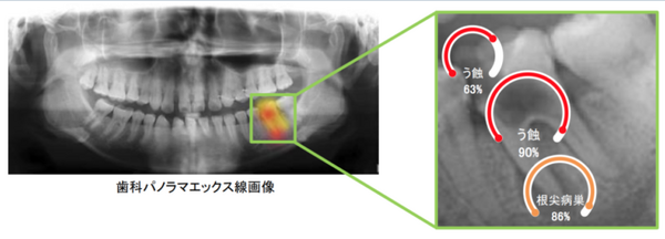 診断速度は医師の6千倍　虫歯など歯の病気を発見する診断AIが開発
