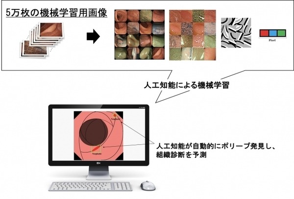 AIを用いた検査支援システム、大腸ポリープの検出感度98%　大腸ガン発生リスクの低減目指す