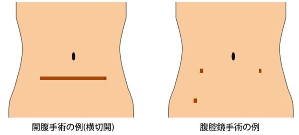 ロボット支援手術が急増！「ダビンチ」とはどんなロボットか? 特長と課題、ロボット手術をとりまく日本の状況を探る(ダビンチ特集 /前編)