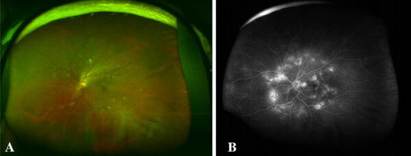 AIが眼底画像を見て糖尿病網膜症をチェック　97%の精度で判定することに成功　Ristがツカザキ病院眼科と連携