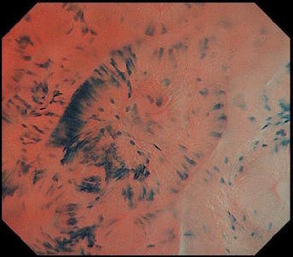 内視鏡検査で「医師とAIの目」が二重に異常をチェック　AI大腸がん診断支援「EndoBRAIN（エンドブレイン）」導入　きはしクリニック