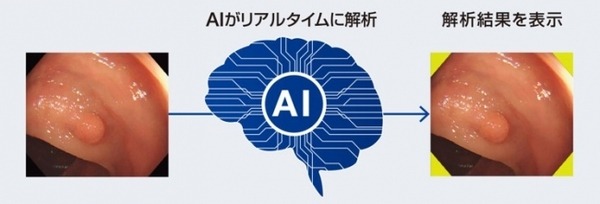 オリンパス　AIが内視鏡検査中にポリープや癌などを発見して警告する「EndoBRAIN-EYE」発売へ　病変検出用AIは国内初の承認