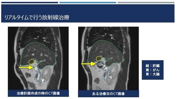 NVIDIAがリアルタイムの放射線治療を目指して医療分野で連携　AIが腫瘍と周辺の正常な臓器の輪郭を識別