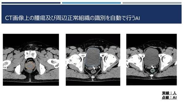 NVIDIAがリアルタイムの放射線治療を目指して医療分野で連携　AIが腫瘍と周辺の正常な臓器の輪郭を識別