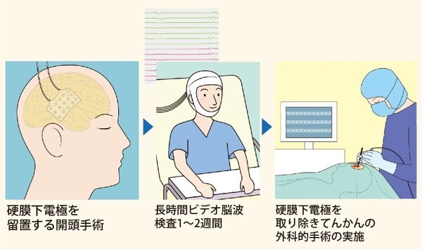 【国内初症例】脳神経外科のロボット支援手術を順天堂が実施　ジンマーバイオメット「ROSA One」で頭蓋内深部電極植込術