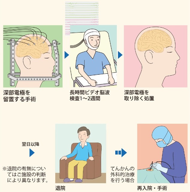【国内初症例】脳神経外科のロボット支援手術を順天堂が実施　ジンマーバイオメット「ROSA One」で頭蓋内深部電極植込術