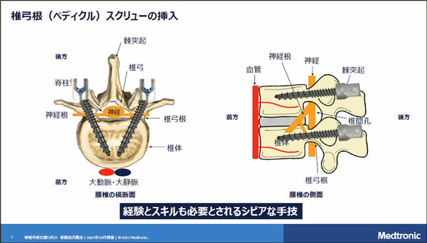 【速報】脊椎固定術の手術支援ロボットシステム「Mazor X」のしくみと特徴を日本メドトロニックが公開
