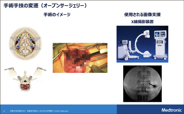 【速報】脊椎固定術の手術支援ロボットシステム「Mazor X」のしくみと特徴を日本メドトロニックが公開