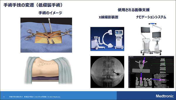 【速報】脊椎固定術の手術支援ロボットシステム「Mazor X」のしくみと特徴を日本メドトロニックが公開