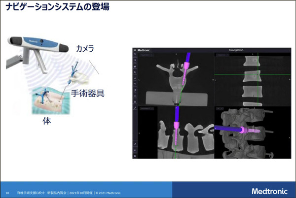 【速報】脊椎固定術の手術支援ロボットシステム「Mazor X」のしくみと特徴を日本メドトロニックが公開