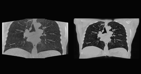 オランダがん研究所 NVIDIA AI Enterpriseで腫瘍の位置を特定できるディープラーニングモデルを構築