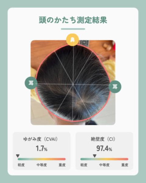 スマホで撮影して赤ちゃんの頭のゆがみ度をAIが測定・可視化する「頭のかたちAI測定」をリリース