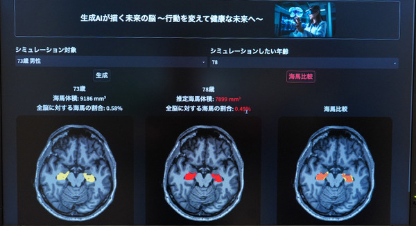 「5年後、認知機能に影響する脳の海馬はどれだけ萎縮する?」ドコモが将来の脳画像を予測する生成AIを開発 海馬の体積変化を可視化