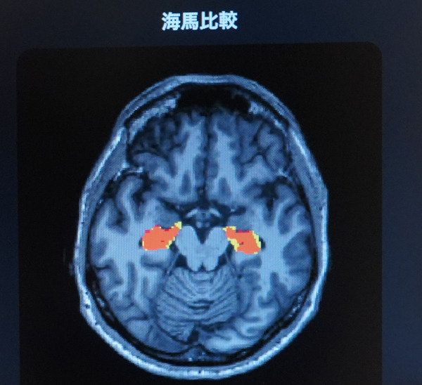 「5年後、認知機能に影響する脳の海馬はどれだけ萎縮する?」ドコモが将来の脳画像を予測する生成AIを開発 海馬の体積変化を可視化