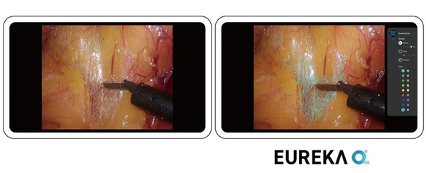 【国内初】外科医の視覚認識をAIがリアルタイムに支援するプログラム医療機器「Eureka α」が薬事承認を取得