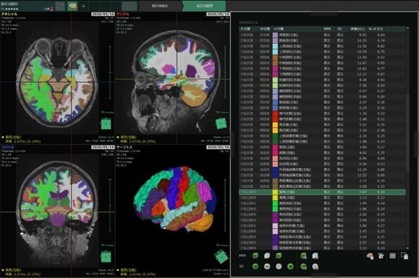 順天堂大学と富士フイルム　AIを用いた脳容積解析ソフトウェアを開発　MRIでの容積解析の汎用化に期待