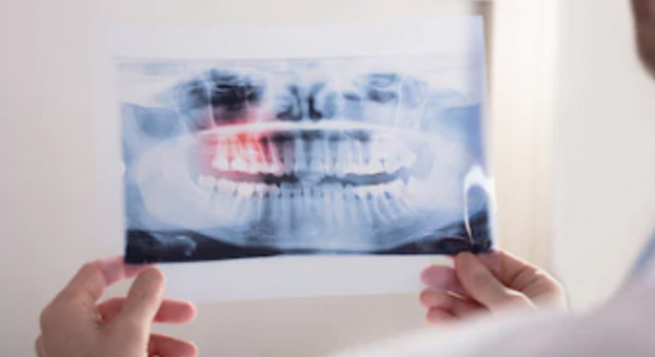 診断速度は医師の6千倍　虫歯など歯の病気を発見する診断AIが開発 画像