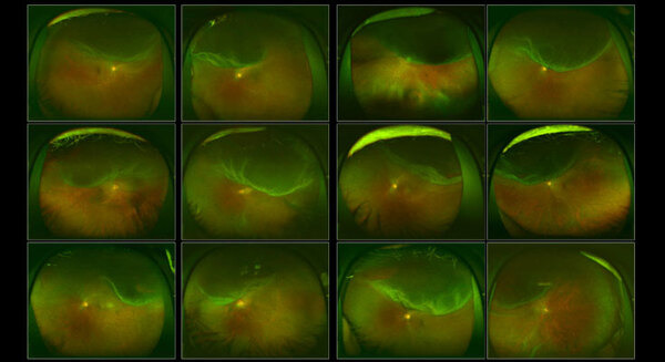 AI技術「GAN」を用いた本物そっくりな網膜剥離画像生成技術を開発　イーグロースとツカザキ病院眼科 画像