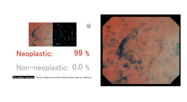 内視鏡検査で「医師とAIの目」が二重に異常をチェック　AI大腸がん診断支援「EndoBRAIN（エンドブレイン）」導入　きはしクリニック 画像