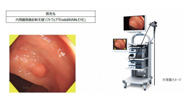 オリンパス　AIが内視鏡検査中にポリープや癌などを発見して警告する「EndoBRAIN-EYE」発売へ　病変検出用AIは国内初の承認 画像