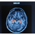 「5年後、認知機能に影響する脳の海馬はどれだけ萎縮する?」ドコモが将来の脳画像を予測する生成AIを開発 海馬の体積変化を可視化