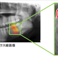 診断速度は医師の6千倍　虫歯など歯の病気を発見する診断AIが開発