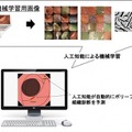 AIを用いた検査支援システム、大腸ポリープの検出感度98%　大腸ガン発生リスクの低減目指す