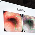 AIスタートアップ企業の最優秀作品を選ぶ「Inceptionアワード」、受賞したのは「内視鏡AIでがんの見逃しゼロへ」【GTC Japan 2018】