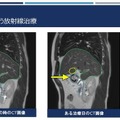 NVIDIAがリアルタイムの放射線治療を目指して医療分野で連携　AIが腫瘍と周辺の正常な臓器の輪郭を識別