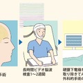【国内初症例】脳神経外科のロボット支援手術を順天堂が実施　ジンマーバイオメット「ROSA One」で頭蓋内深部電極植込術