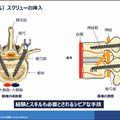 【速報】脊椎固定術の手術支援ロボットシステム「Mazor X」のしくみと特徴を日本メドトロニックが公開