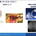 【速報】脊椎固定術の手術支援ロボットシステム「Mazor X」のしくみと特徴を日本メドトロニックが公開