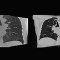 オランダがん研究所 NVIDIA AI Enterpriseで腫瘍の位置を特定できるディープラーニングモデルを構築