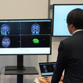 「5年後、認知機能に影響する脳の海馬はどれだけ萎縮する?」ドコモが将来の脳画像を予測する生成AIを開発 海馬の体積変化を可視化