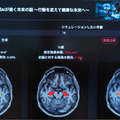 「5年後、認知機能に影響する脳の海馬はどれだけ萎縮する?」ドコモが将来の脳画像を予測する生成AIを開発 海馬の体積変化を可視化