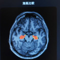 「5年後、認知機能に影響する脳の海馬はどれだけ萎縮する?」ドコモが将来の脳画像を予測する生成AIを開発 海馬の体積変化を可視化