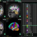 順天堂大学と富士フイルム　AIを用いた脳容積解析ソフトウェアを開発　MRIでの容積解析の汎用化に期待